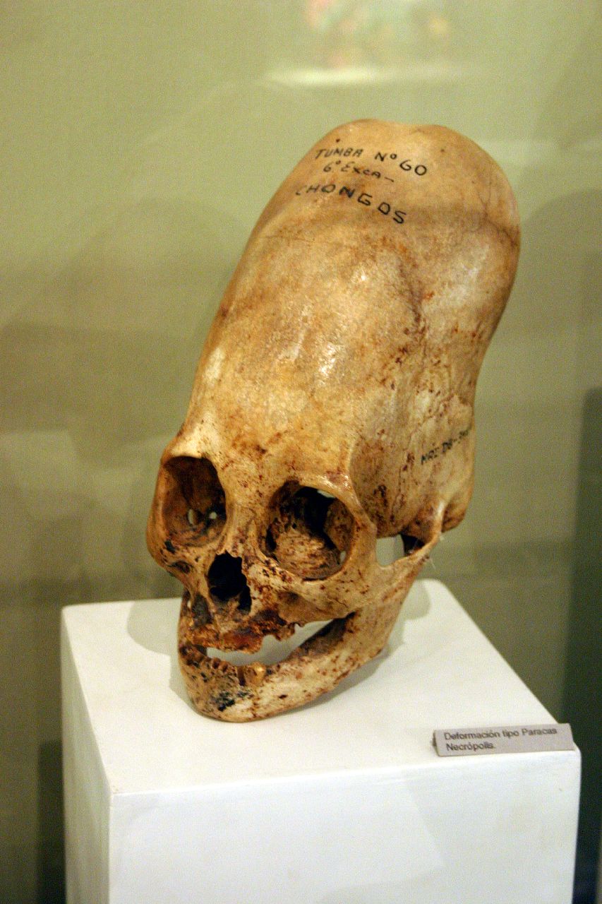 inca cranial deformation